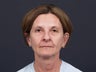 61 year old female with facial aging.