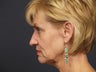 57 year old with facial aging. 