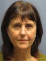 Neck Lift, Platysmaplasty
