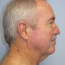 Necklift