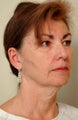 Neck Lift
