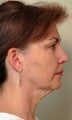 Before and After Neck Lift (Side View)