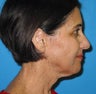 Limited Incision Neck Lift