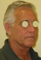 Limited incision neck lift