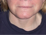 Neck Lift