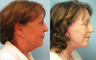 Facelift, Neck lift, Lower Blepharoplasty (eyelid lift), Nd:YAG laser resurfacing