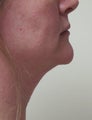 Neck Lift