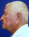 Neck Lift