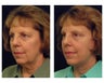 Lower Facelift and Neck