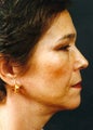 Necklift 