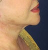 Neck Lift