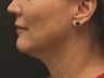 Neck Lift