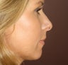 Neck Lift and Upper Eyelid Blepharoplasty