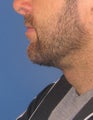 Neck lift