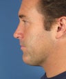 Neck lift