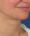 Neck lift