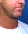 Neck lift