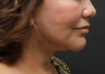 Facelift, Neck Lift, Lipocontouring of Neck