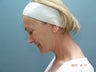 Neck Lift