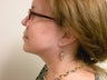 Neck Lift 