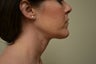 Neck Lift/Face Lift 