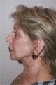 Neck Lift 