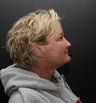 neck lift