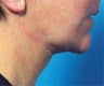 Necklift