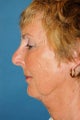 Weekend Necklift 