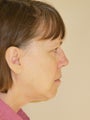 Neck Liposuction