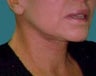 Neck Lift