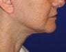 Neck Lift