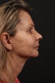 Neck lift
