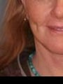 Facial Refinement: Necklift