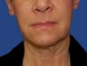 Jawline / Neck Lipo