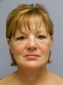 Lower Face with Neck Lift