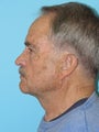 Necklift
