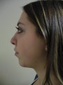 Neck Lift