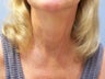 Neck lift