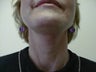 Neck lift