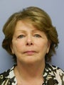 Lower Face with Neck Lift
