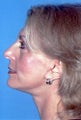 Neck Lift