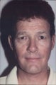 Male Neck Lift