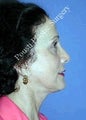 Neck Lift