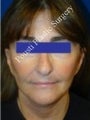 Face Lift, Facial Enhancement, Neck Lift
