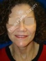 Face Lift, Neck Lift