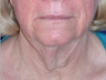 Neck Lift