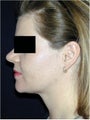 Neck Lift