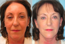 Facelift, Neck lift, Lower Blepharoplasty (eyelid lift), Nd:YAG laser resurfacing