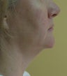 Neck Lift